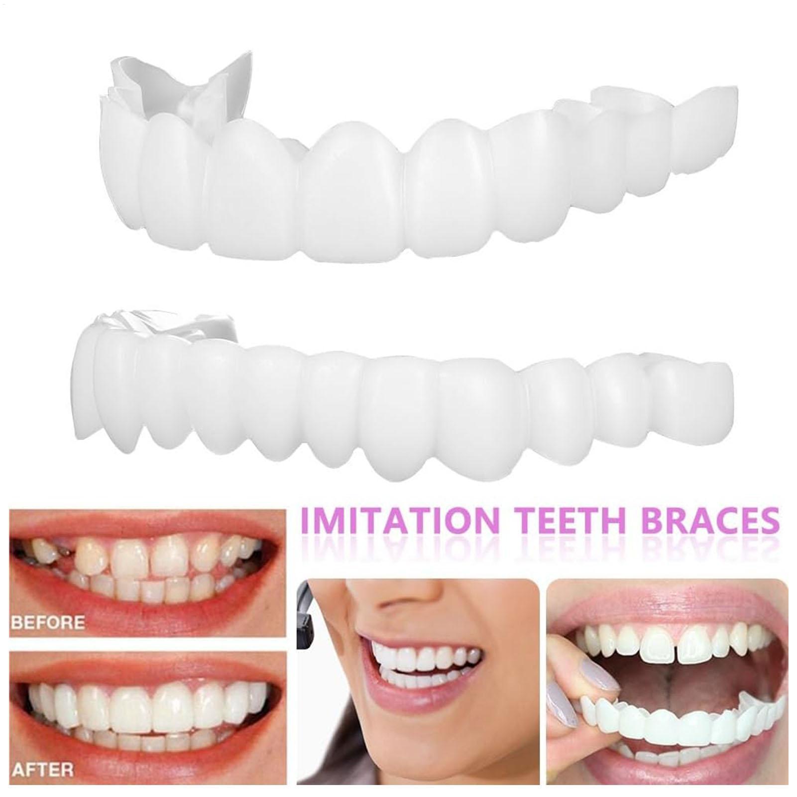 Prothèses dentaires supérieure - Teeth Whitening With Braces avis et prix