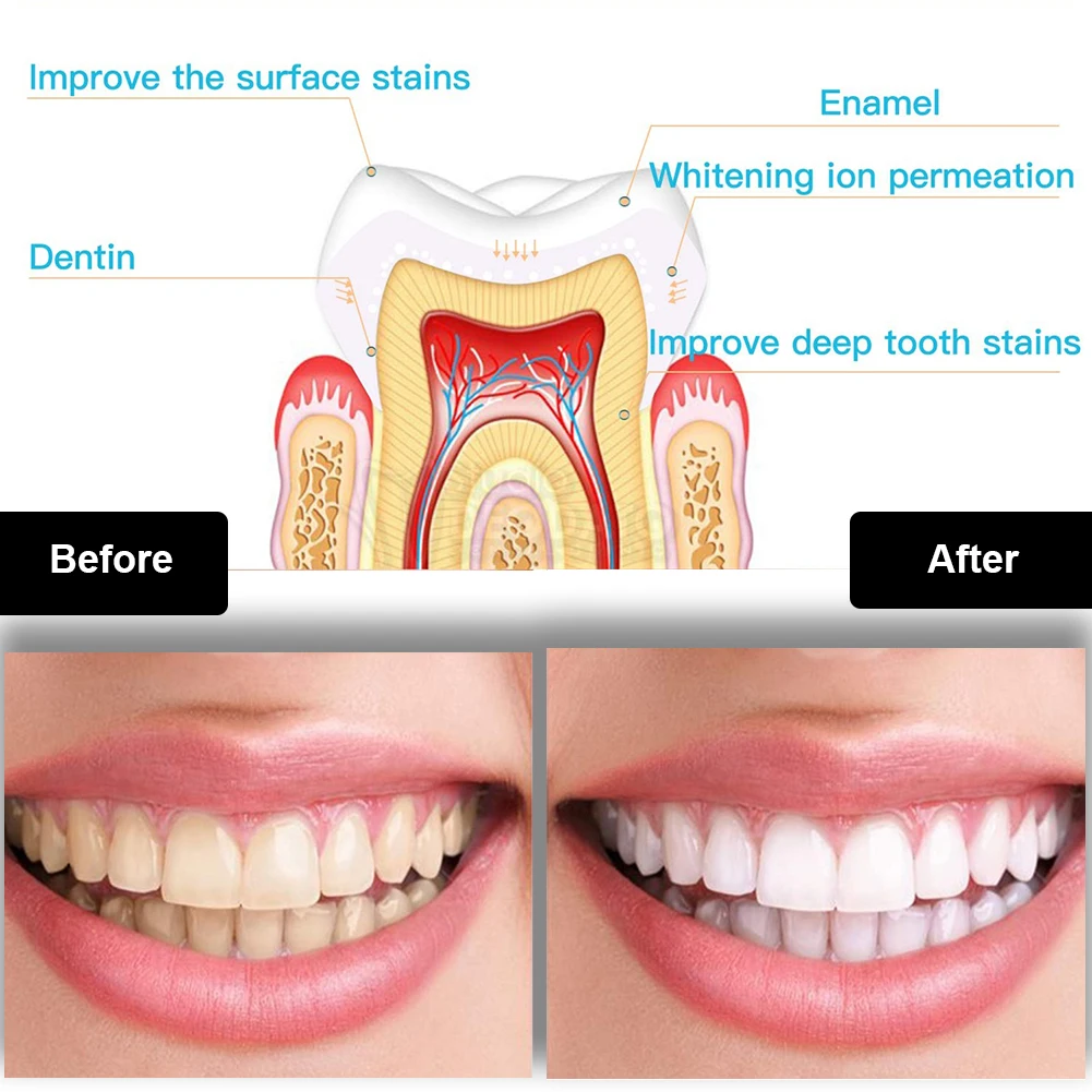 Kit de blanchiment des dents d - Teeth Whitening With Peroxide avis et prix