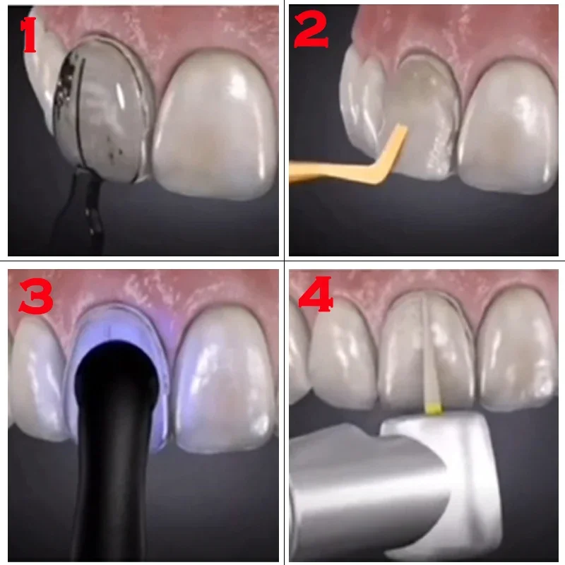 Moule dentaire pour placages e - Teeth Whitening Moulds avis et prix