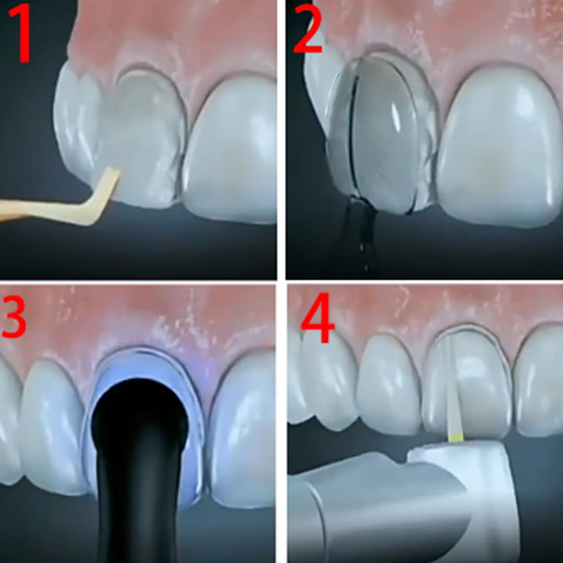 Kit de moule de placage dentai - Teeth Whitening Moulds avis et prix